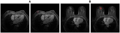 A coarse-to-fine and automatic algorithm for breast diagnosis on multi-series MRI images